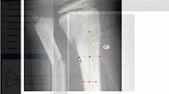 TraumaCad - Metaphyseal Fracture Angulation