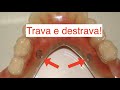 PRÓTESE FIXA QUE A PESSOA CONSEGUE REMOVER? COMO ASSIM? CONHEÇA O MK1!