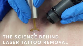 The Science behind Laser Tattoo Removal