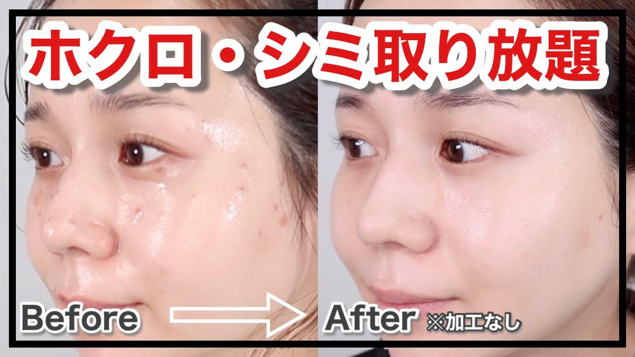 【ホクロ・シミ取り】レーザー治療！１０日間の経過報告【アラサー美容】