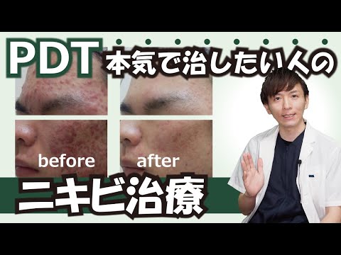 【皮膚科医が解説】みんな知らない本気のニキビ治療PDTを知っていますか？