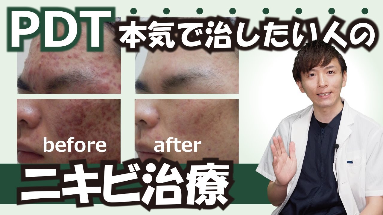 Pdt フォトダイナミックセラピー 重症ニキビ ニキビ跡皮膚科 メディアージュ ニキビクリニック