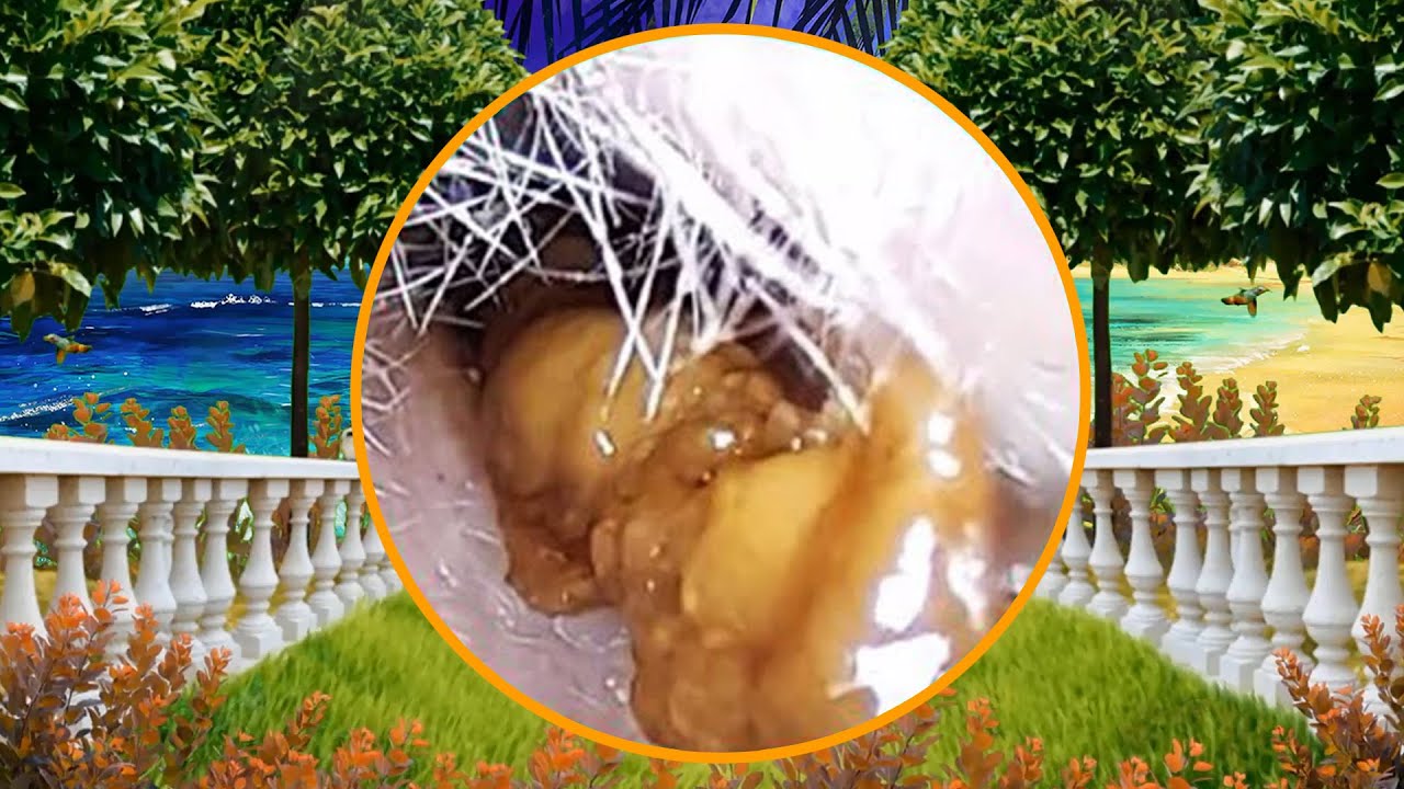 Satisfying Ear Wax Removal With Dr Zhao Video 12 YouTube