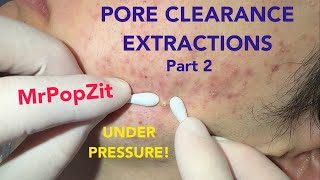 Inflammatory Acne Extractionspops Have Distanceunder Pressure Extraction Pops For Pore Clearance