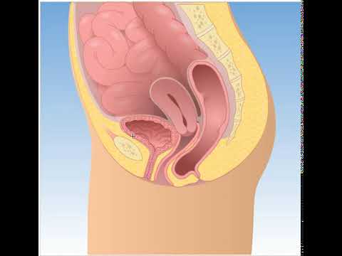 Выпадение прямой кишки во влагалище (ректоцеле)