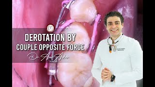 orthodontic derotation of rotated premolar by amr asker