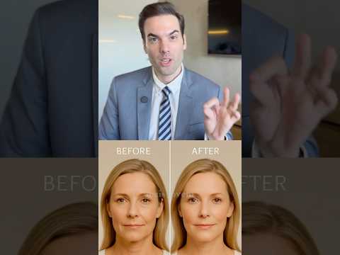 Radiesse não é só volume: como ele estimula colágeno — vídeo do Dr. Thiago Perfeito