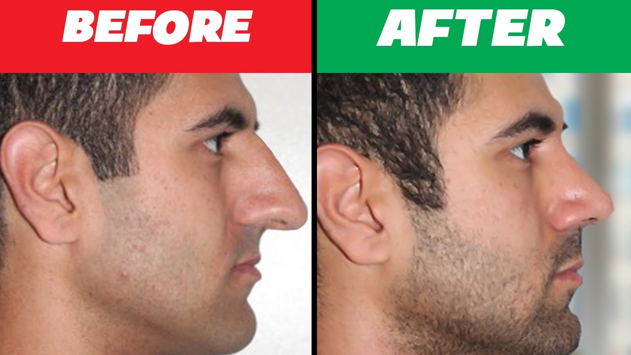 Nose Lift without Surgery & tool/Real & naturally/ YouTube