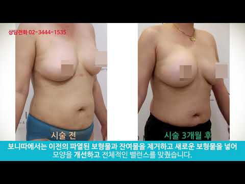 가슴보형물 파열로 인한 교체 사례