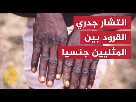 بريطانيا.. تزايد أعداد المصابين بجدري القرود وخبراء يقللون من مخاطر انتشاره