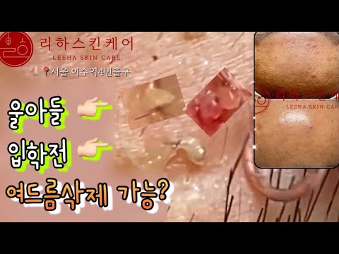 여드름성지,아들 입학전 여드름 삭제!!!