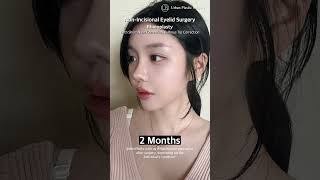 Before U0026 After Plastic Surgery koreanplasticsurgery kbeauty
