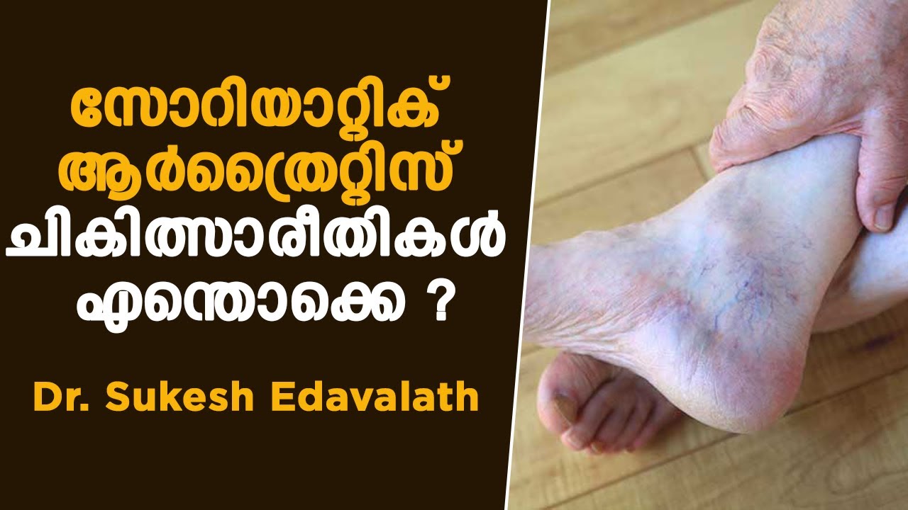 സോറിയാറ്റിക് ആർത്രൈറ്റിസ് ;ചികിത്സാരീതികൾ എന്തൊക്കെയാണ് | Psoriatic Arthritis | Dr. Sukesh Edavalath