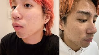 5年間悩んでた肌荒れを綺麗にする方法