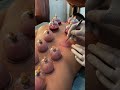 Hijama cupping therapy