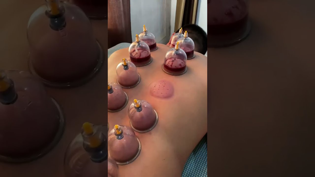 Hijama cupping therapy