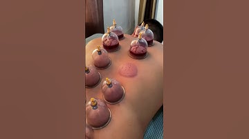 Thumbnail of Hijama (cupping therapy)