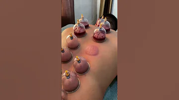 Hijama Cupping Therapy 