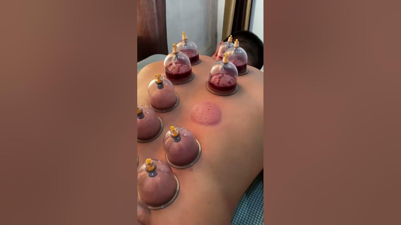 Hijama (cupping therapy)