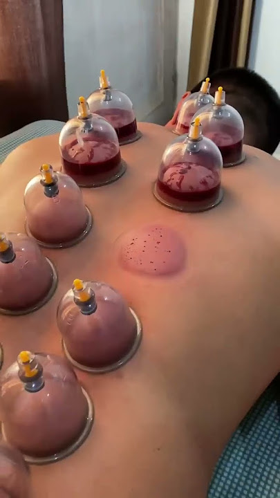Hijama (cupping therapy)