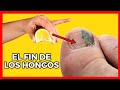 👉👉Solución definitiva para Acabar con los Hongos de las Uñas - Acabar Con los molestos Hongos.