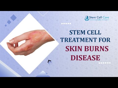 Skin Burns | Best Treatment For Skin Burns | Best Stem Cell Hospital For Skin Burn | Stem Cell |