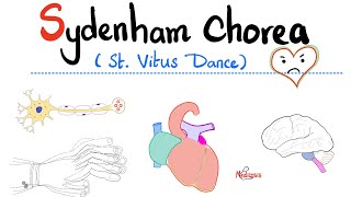 Sydenham Chorea (St. Vitus Dance) - Rheumatic Fever - Neurology & Cardiology