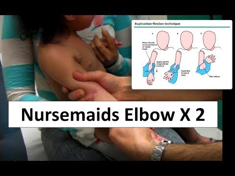 Video: Nursemaid Elbow: Redukce, Ošetření, Domov, Oprava A Další