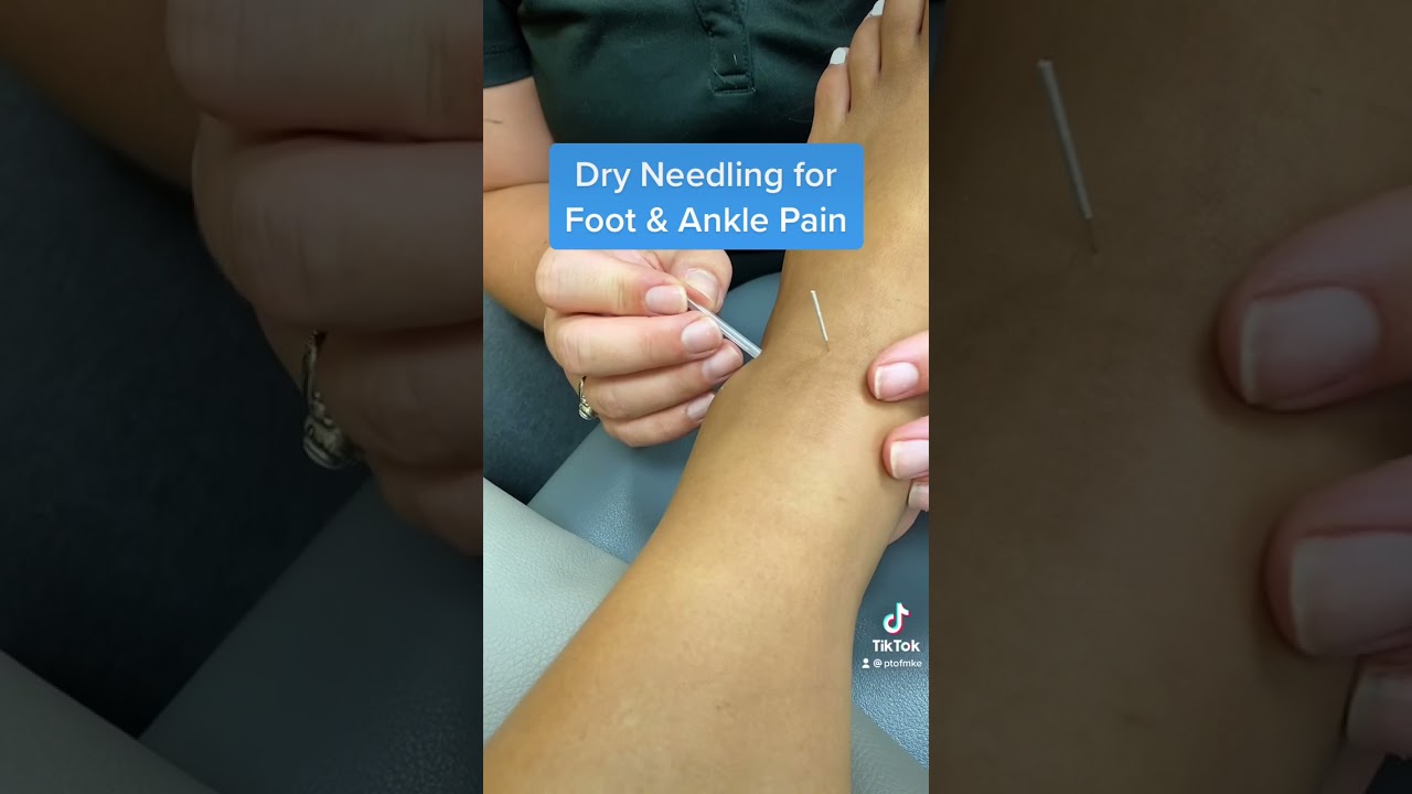 Dry needling for foot & ankle pain. 
