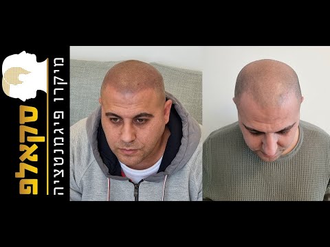 סרטון המלצה על סקאלפ