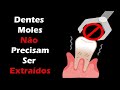 Como Fixar Dentes Moles sem Implante Dentário – Periodontite Tratamento - Raspagem Periodontal