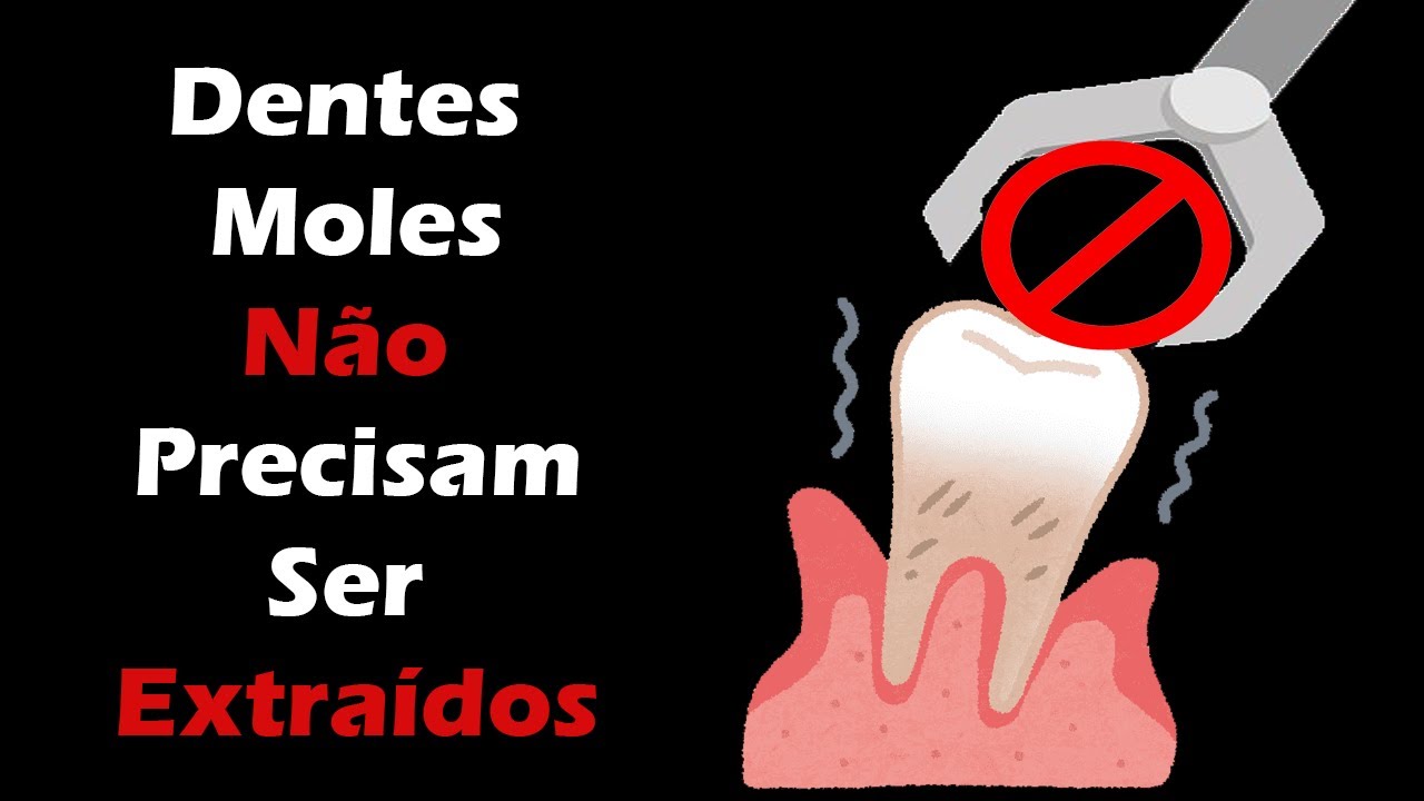 Como Fixar Dentes Moles sem Implante Dentário – Periodontite Tratamento - Raspagem Periodontal