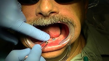 Pick-up of LOCATOR® Denture Caps using Zest