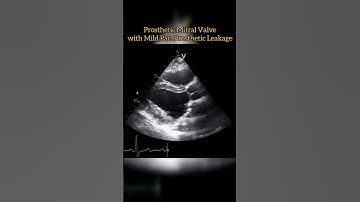 Prosthetic Mitral Valve #echocardiogram #echo   Echocardiography For Beginners