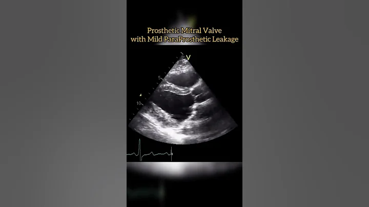 Prosthetic Mitral Valve #echocardiogram #echo   Echocardiography For Beginners