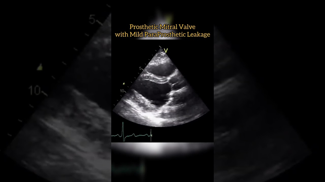 Prosthetic Mitral Valve 