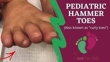 Hammertoes & Curly Toes in Children
