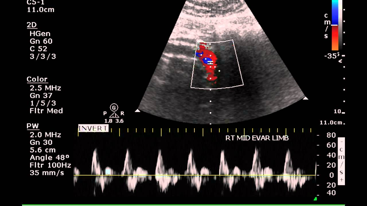 Ultrasound Assessment of an Aortic Endogrft Case Study YouTube
