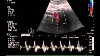 Ultrasound Assessment of an Aortic Endogrft - Case Study