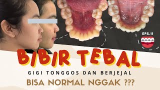 Bibir tebal, gigi tonggos dan berjejal, bisa normal nggak??? Eps. 11