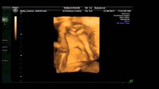 A video of our boy joshua who is due in august. this scan was done at
babybond 27 weeks +4. thanks for watching :)