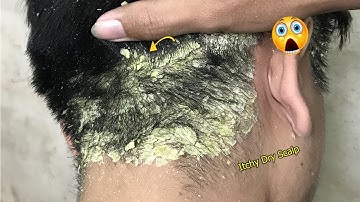 Itchy Dry Scalp Treatment #709 ( Seborrheic dermatitis )