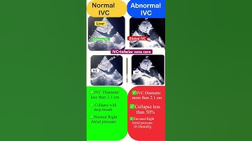What is Collapsing and Non Collapsing IVC #echo #shorts