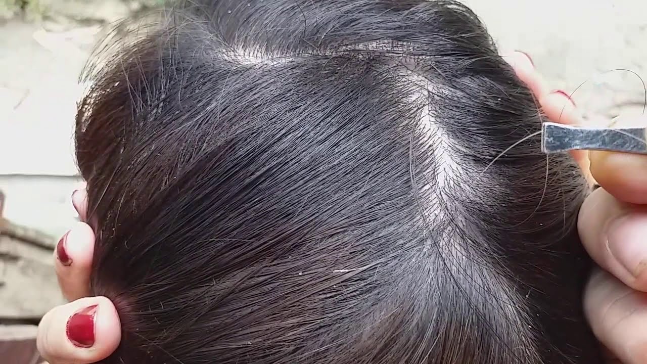 Pluck the head white hair that makes the head itch YouTube