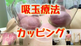 吸い玉療法やってみた２ #カッピング