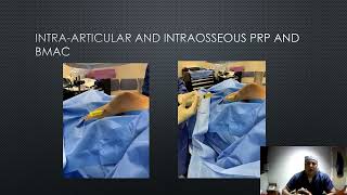 Intraosseous Injection therapy for treatment of Joint Pain Intraosseous Bioplasty Technique For Bone Marrow Lesions Of The Knee Direct Approach
