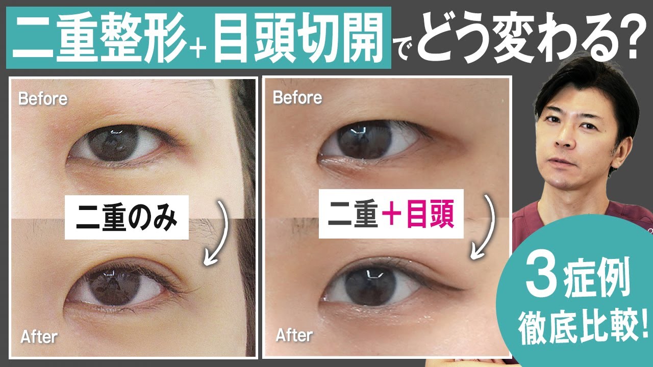 水の森の【目頭切開】徹底解説！二重埋没法・二重切開法と同時に行うメリットとは？おすすめの術式やダウンタイムについて【症例写真有】