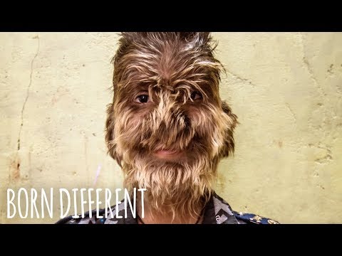 The Boy With ‘Werewolf Syndrome’ | BORN DIFFERENT