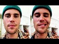 Justin Bieber Says Half His Face Is Paralyzed