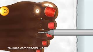 ASMR Treatment athletes foot and warts between toes at home   //   Foot care animation //   - asmr